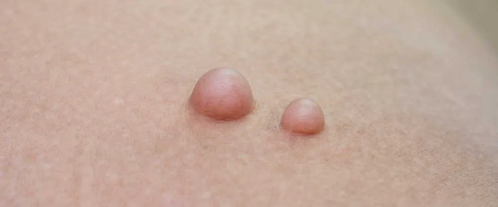 Yağ bezelerinin 4 özelliğine dikkat