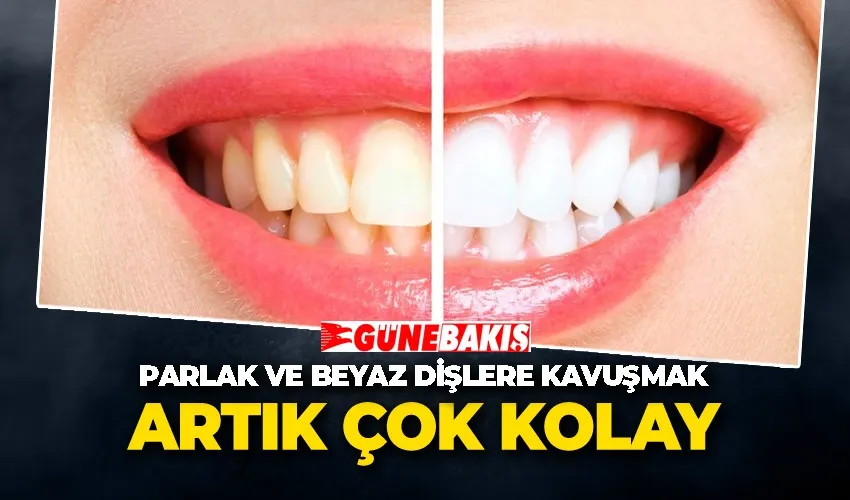 Parlak ve Beyaz Dişlere Kavuşmak Artık Çok Kolay