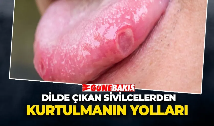 Dilde Çıkan Sivilcelerden Kurtulmanın Yolları