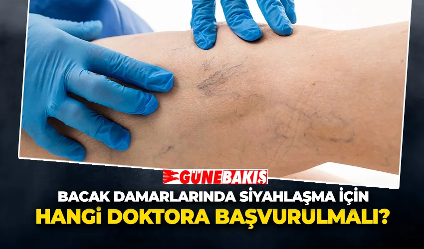 Bacak Damarlarında Siyahlaşma İçin Hangi Doktora Başvurulmalı?