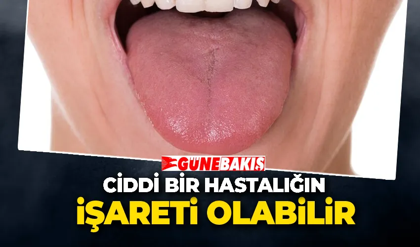 Dilinize Dikkat Edin: Beyazlık, Ciddi Bir Hastalığın İşareti Olabilir