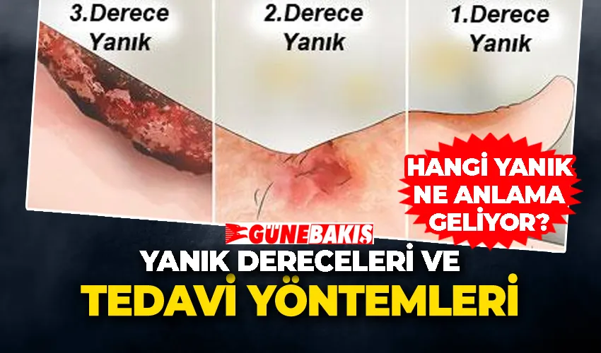Yanık Dereceleri ve Tedavi Yöntemleri: Hangi Yanık Ne Anlama Geliyor?