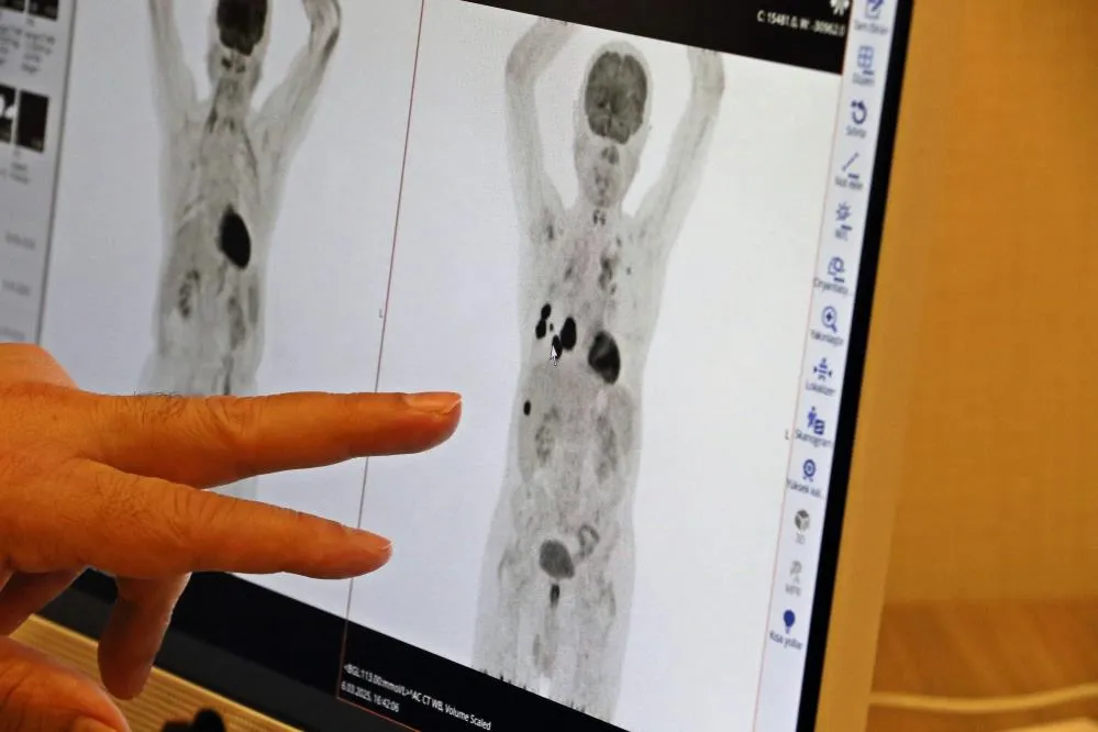 Akciğer kanseri tedavisinde sağ kalım oranları artıyor