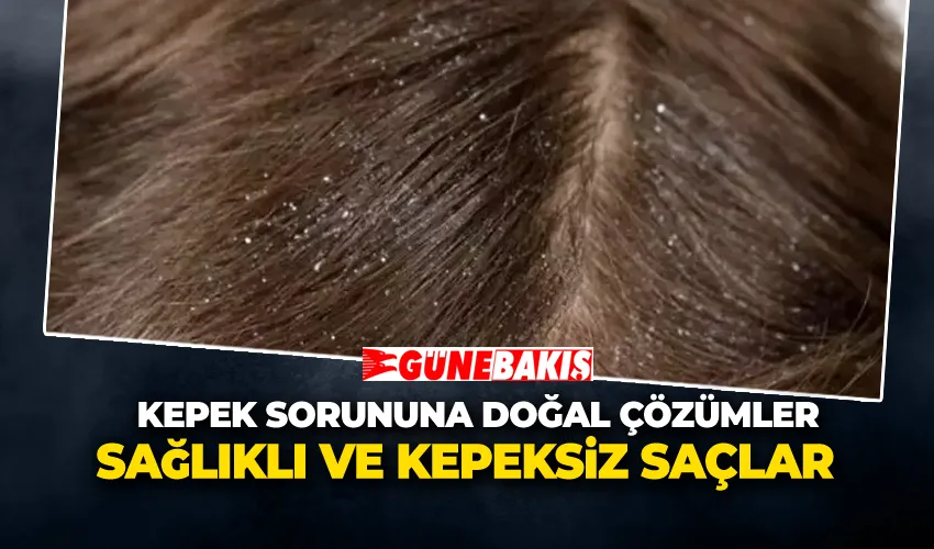 Kepek Sorununa Doğal Çözümler: Sağlıklı ve Kepeksiz Saçlar 