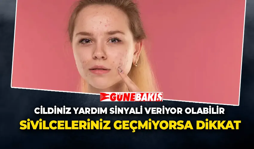 Sivilceleriniz Geçmiyorsa Dikkat: Cildiniz Yardım Sinyali Veriyor Olabilir