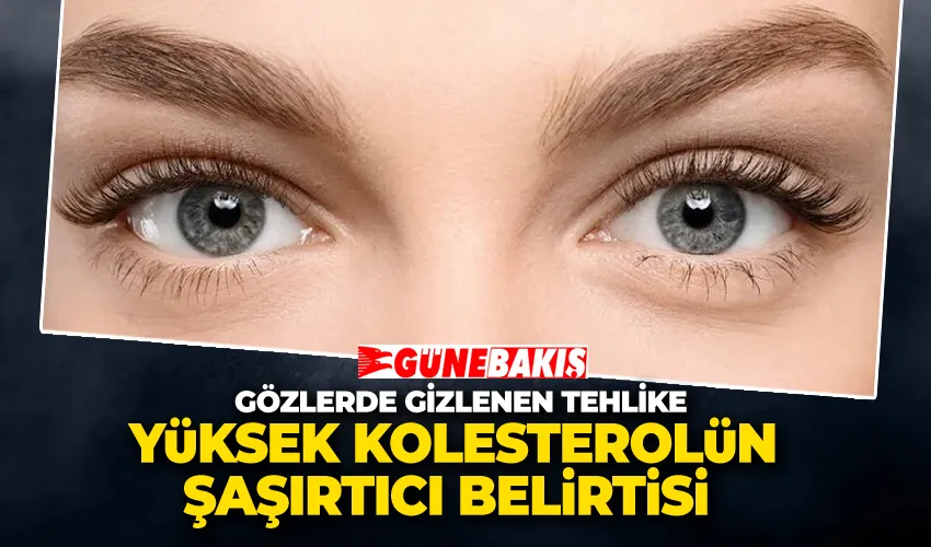 Gözlerde Gizlenen Tehlike: Yüksek Kolesterolün Şaşırtıcı Belirtisi