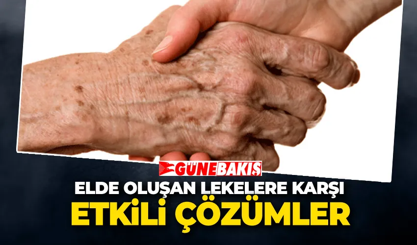 Elde Oluşan Lekelere Karşı Etkili Çözümler