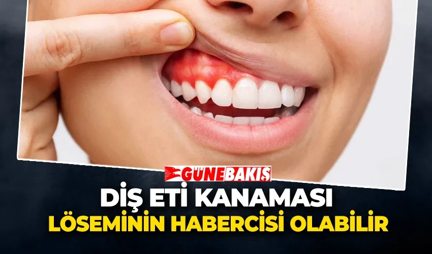 Diş Eti Kanaması Löseminin Habercisi Olabilir
