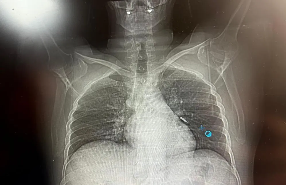 İmplant vidası ciğerine kaçan hasta ölümden döndü