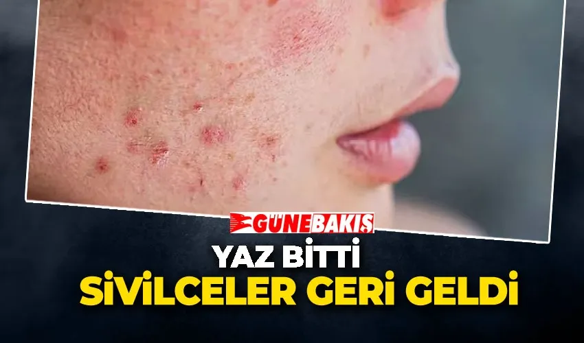 Yaz Bitti Sivilceler Geri Geldi